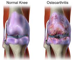 knee pain shalimar bagh knee pain shalimar bagh