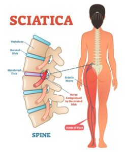 sciatica pain treatment shalimarbagh